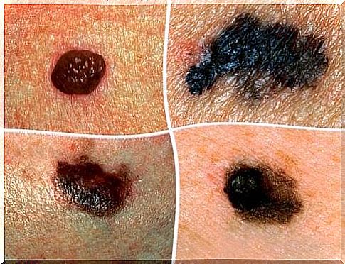 Mole affected by skin cancer 