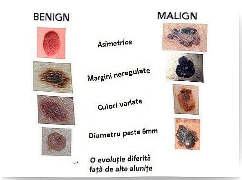 Symptoms of skin cancer present in moles