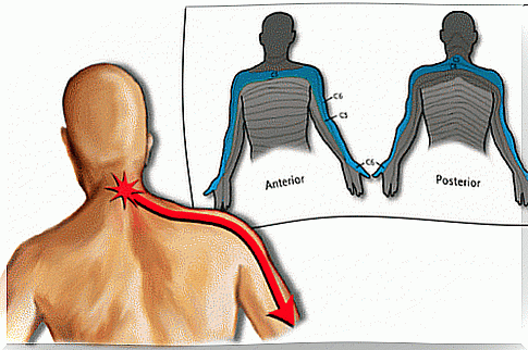 Cervical-brachial neuralgia causing shoulder pain