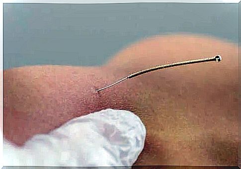 Dry needling therapy - description and benefits