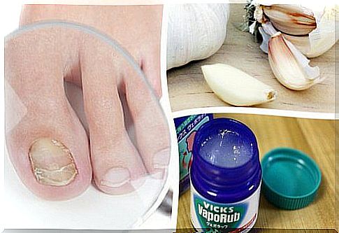 Fungal nail infections: 7 remedies