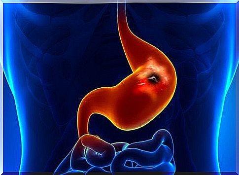 Gastric ulcer is caused by a bacterium