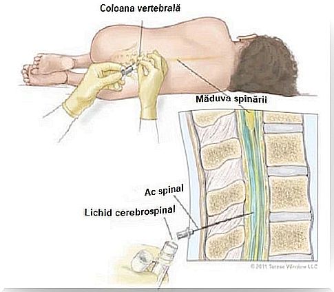 Patient affected by headache after lumbar puncture