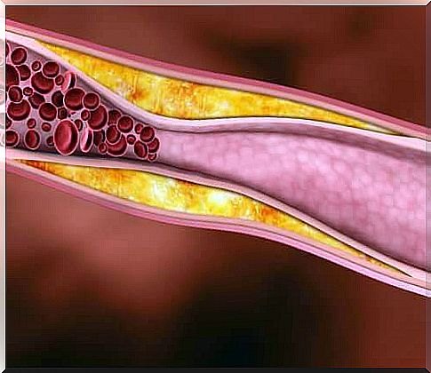 Cholesterol in the arteries