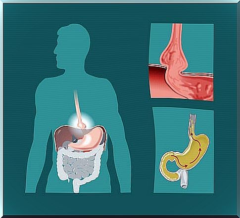 Hiatal henia is a condition of the digestive system