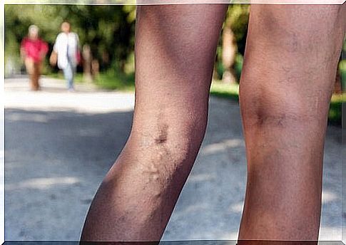 How to remove unsightly varicose veins on the legs