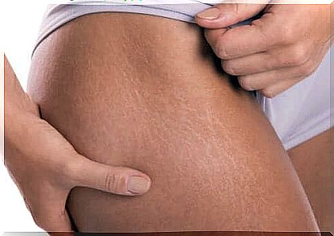 How to prepare an anti-stretch mark cream with vitamin E.