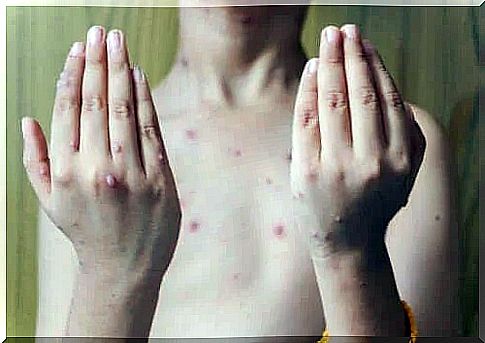 Shingles in children: symptoms and treatment