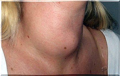 Swelling in the neck