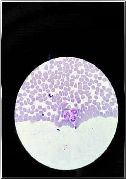 Symptoms of agranulocytosis and types of treatment