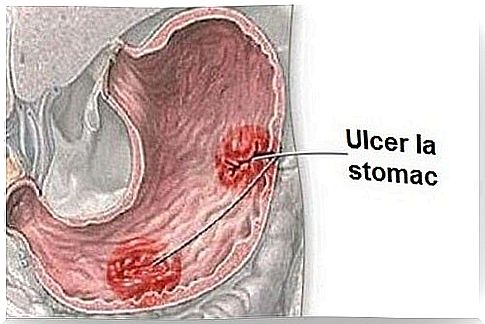 Symptoms of gastric ulcer