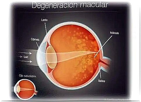 Macular degeneration in humans