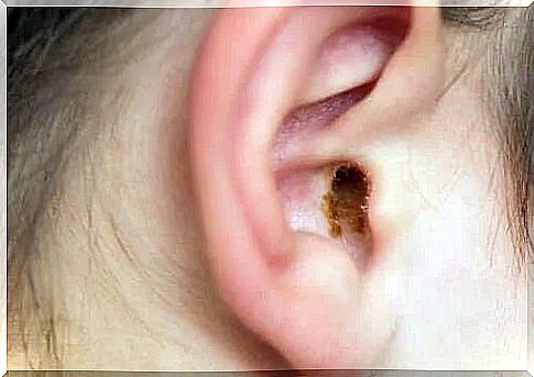 Treatment of ear plugs