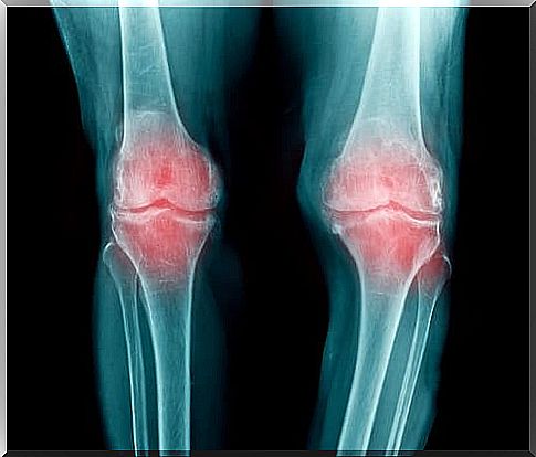 Causes of tingling in the joints such as rheumatoid arthritis 