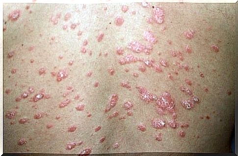 What is psoriasis and how many types are there?