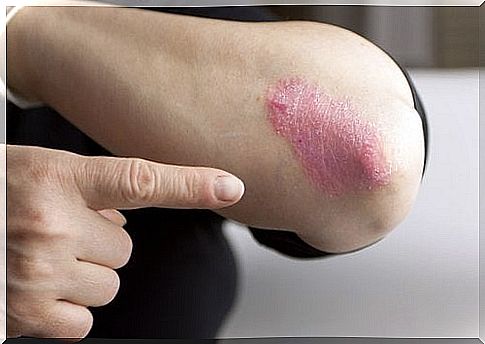 Lesions caused by plaque psoriasis