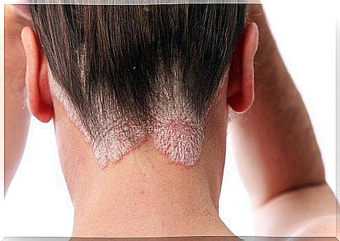 Psoriasis causes skin lesions and itching