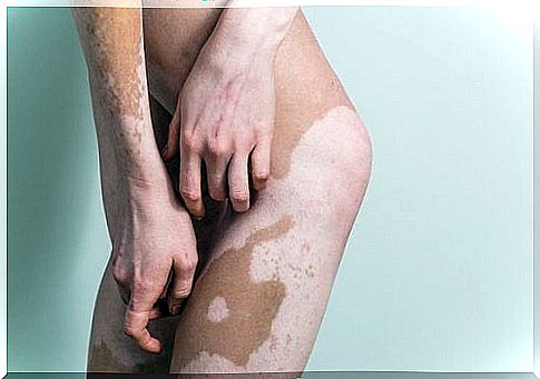 What is vitiligo and what are its causes and treatment?